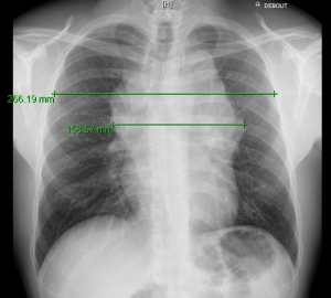 Mesure Du Rapport Mt Sur Radio Thorax Lymphoma Care