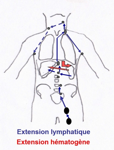 Site initial inguinal - iliaque