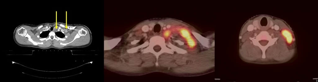 Stade II2A médiastin cervical gauche Stade II2A médiastin cervical gauche rapport MT 0.24 VS 18 mm