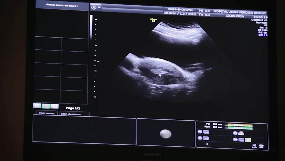 implantation d'embryon