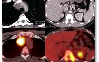 Bilan initial, changement de stade grâce à la TEP (Stade II à IV). Découverte de lésions osseuses sur la TEP invisibles au scanner.