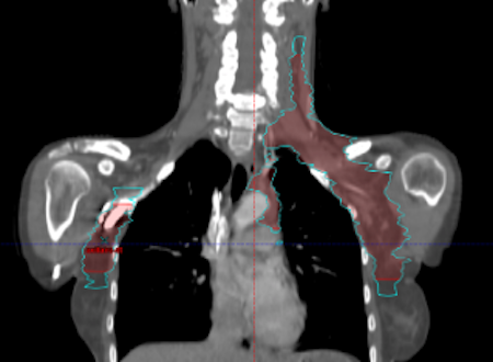 Radiotherapie involved-node (rouge) et involved-site (bleu)